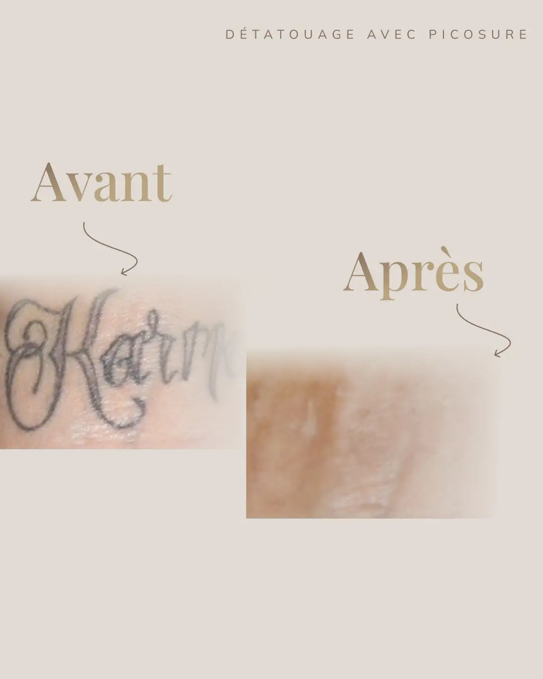 Une image avant après d'un détatouage de nom réalisé par la technologie picosure pro à la clinique dermamédibeauté situé à Laval.