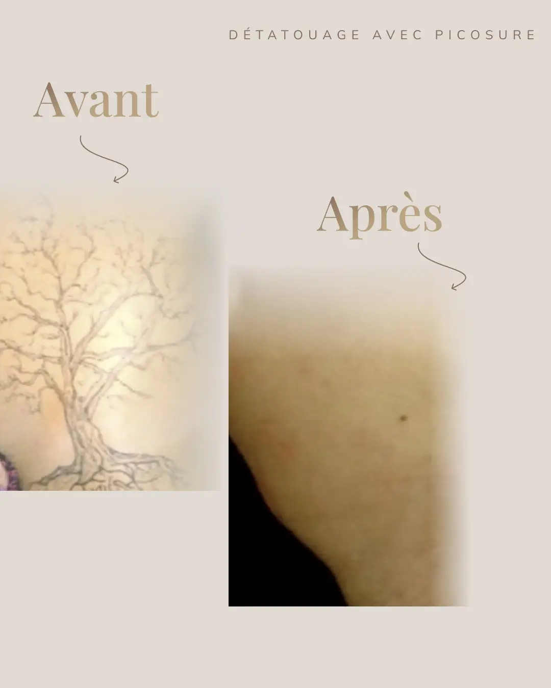 Une image avant après d'un détatouage réalisé par la technologie picosure pro à la clinique dermamédibeauté situé à Laval.