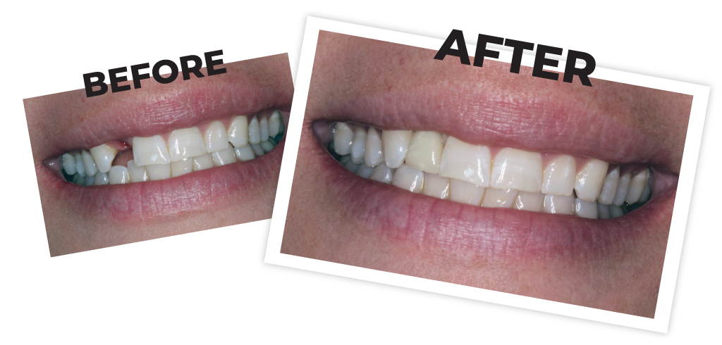 dental implant surgery Landisville, PA
