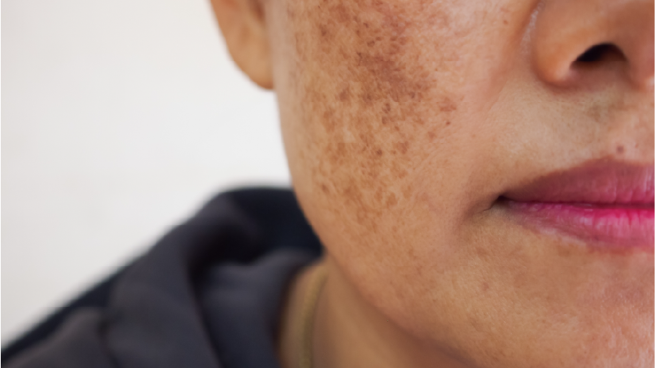 Pigmentation Removal