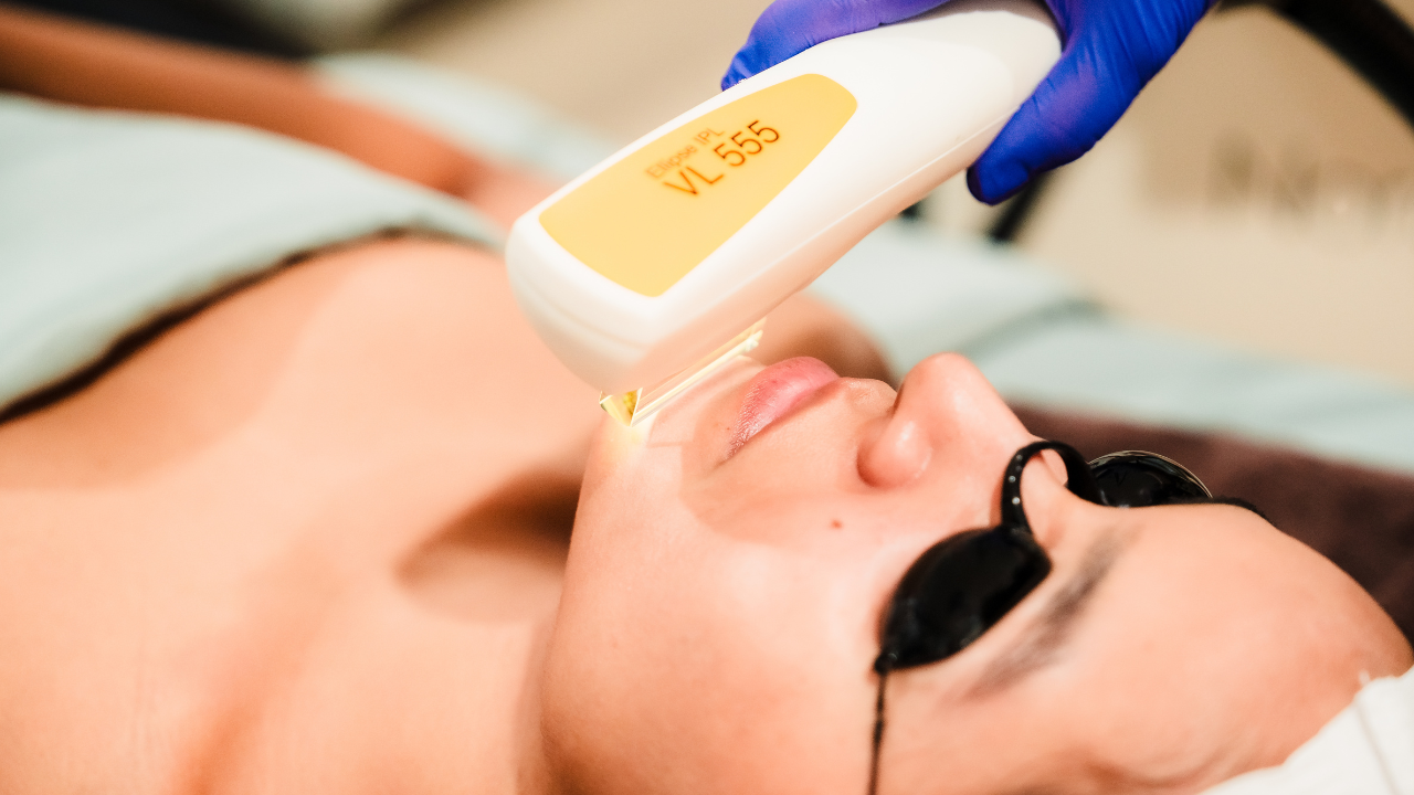 IPL Photofacial 