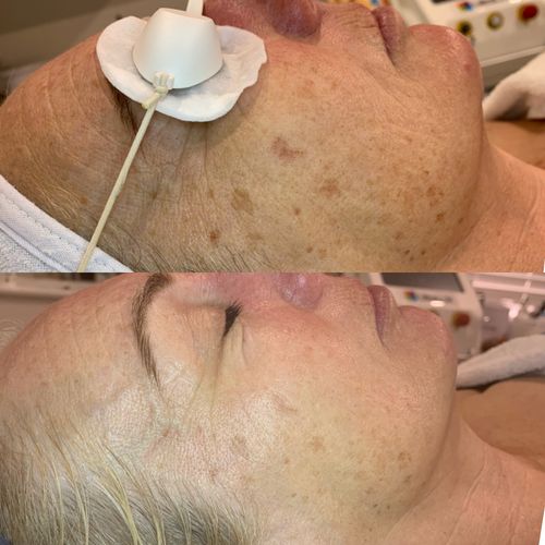 IPL facial therapy for pigmentation before and after image