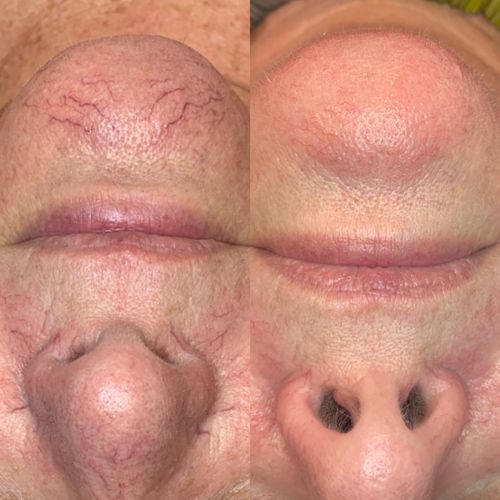 IPL facial therapy for broken capillaries before and after image