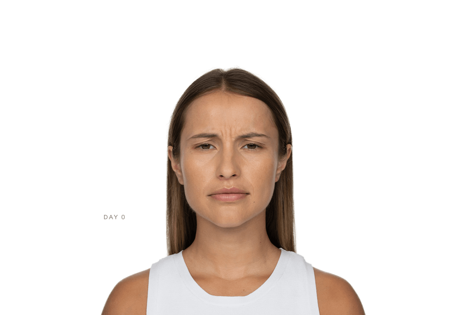 Jeuveau before image at maximum frown from official Evolus results gallery