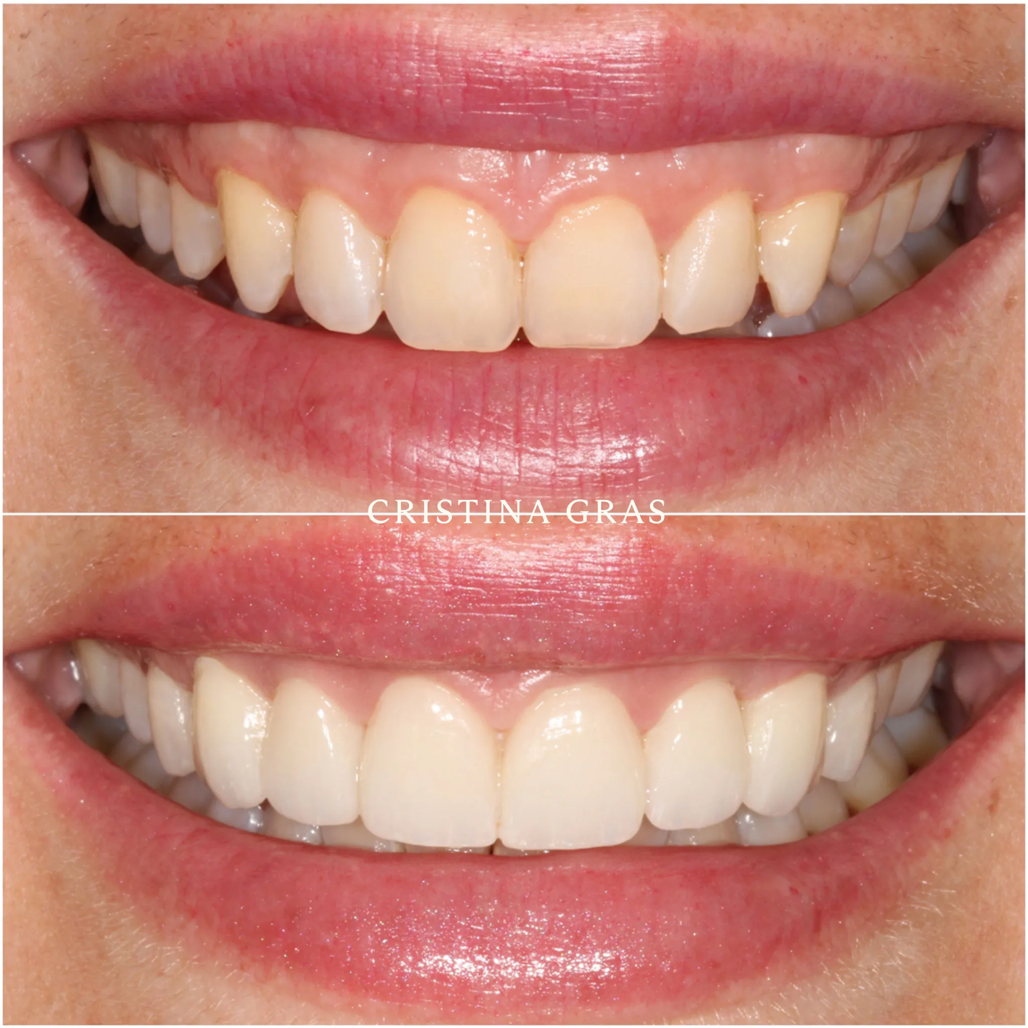 Diseño de sonrisa personalizado con carillas de alta precisión