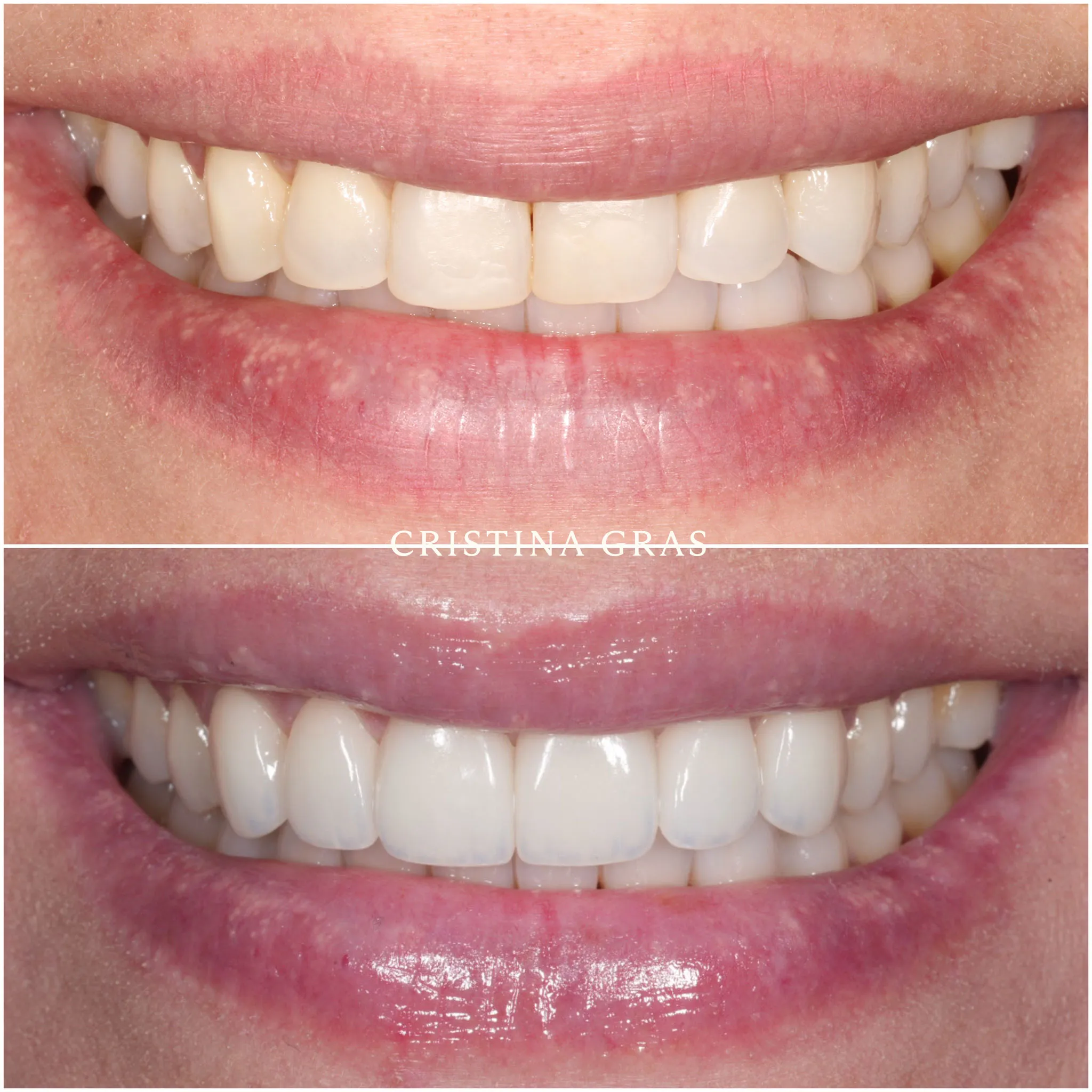 Mejoría estética mediante tratamiento adhesivo con microcarillas