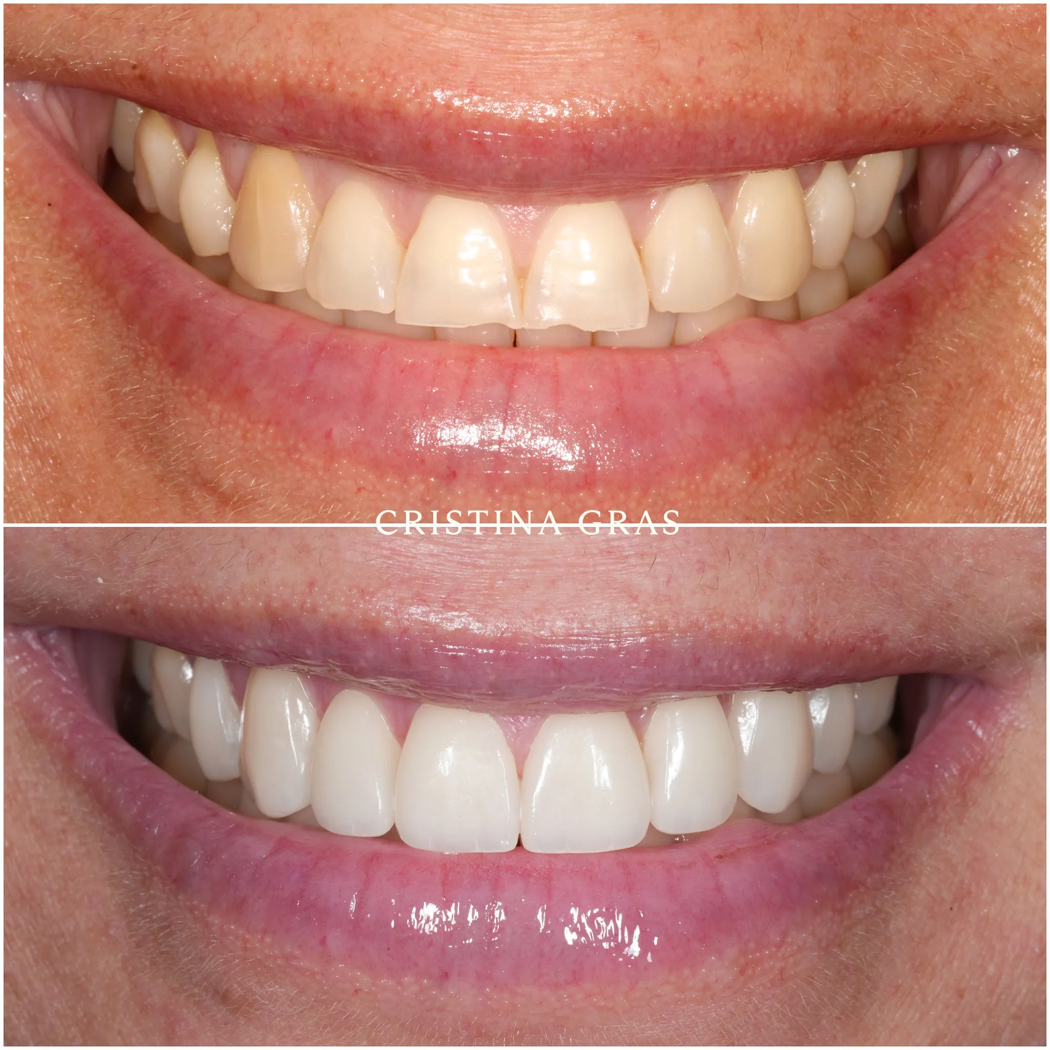 Antes y después de corrección desgaste dental con carillas