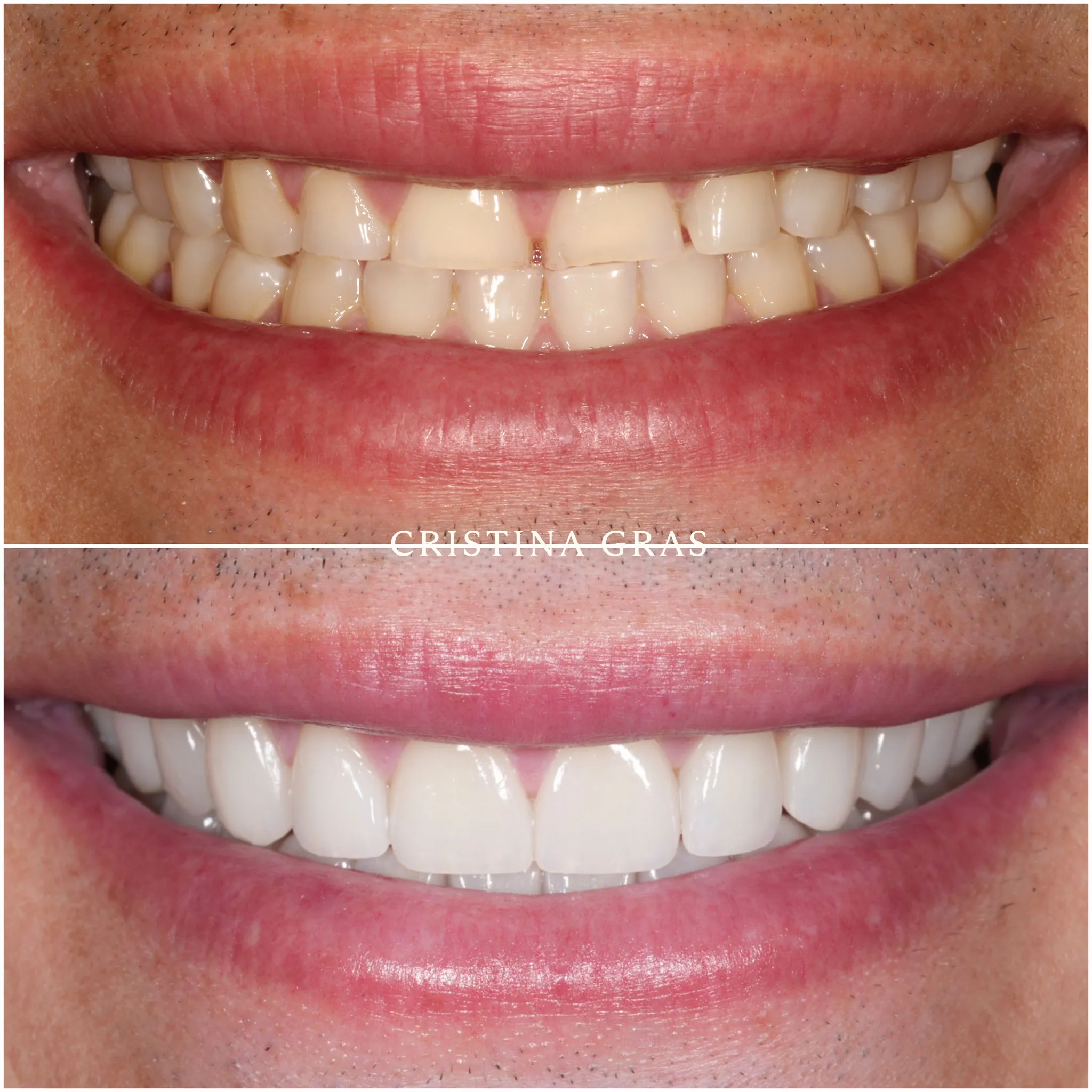 Antes y después con microcarillas adhesivas