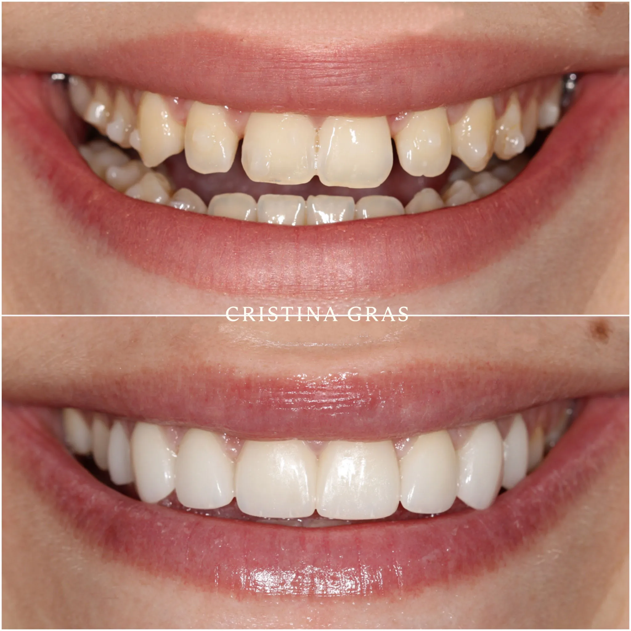 Cambio de sonrisa sin tallado dental con carillas ultra finas