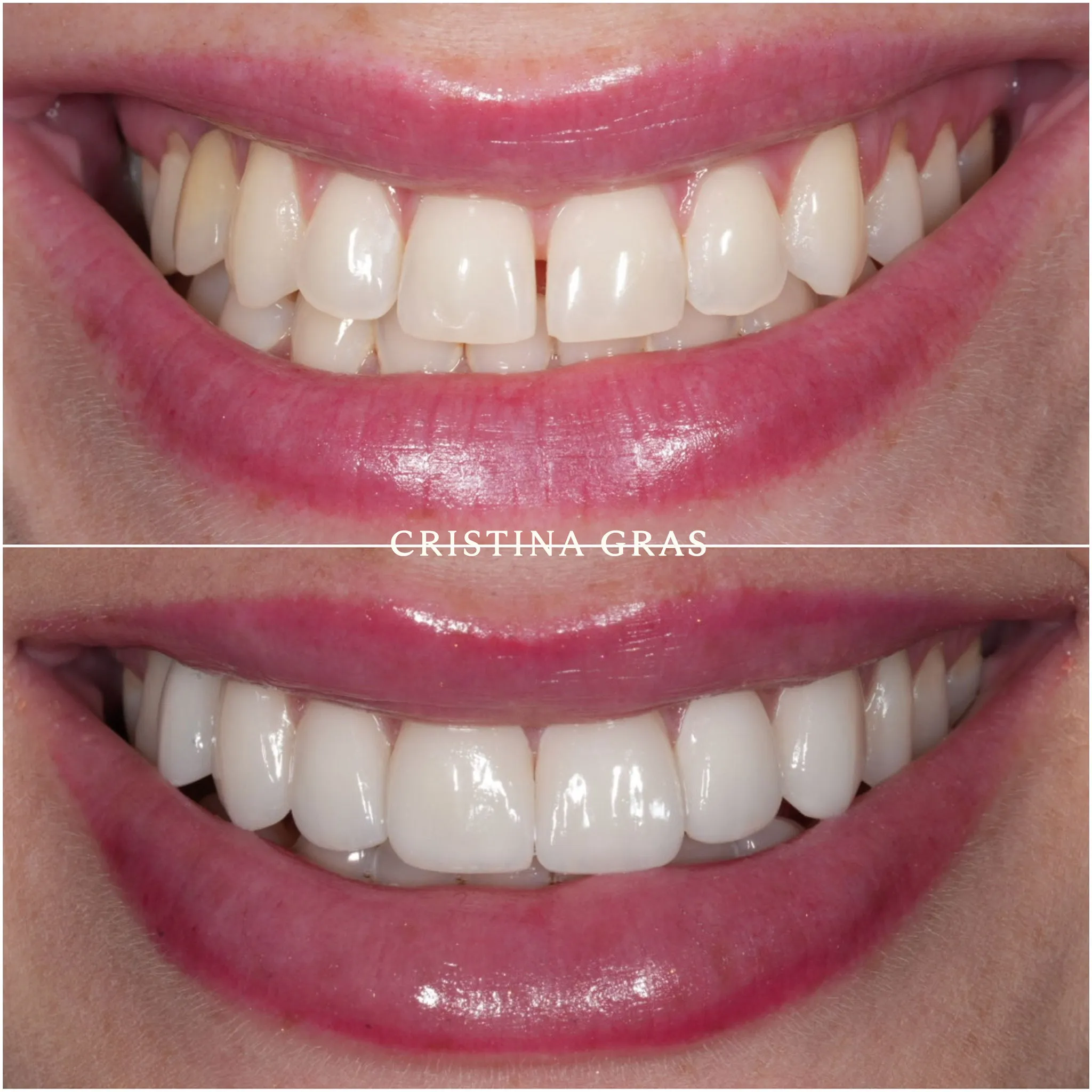 Antes y después de tratamiento con carillas finas de porcelana