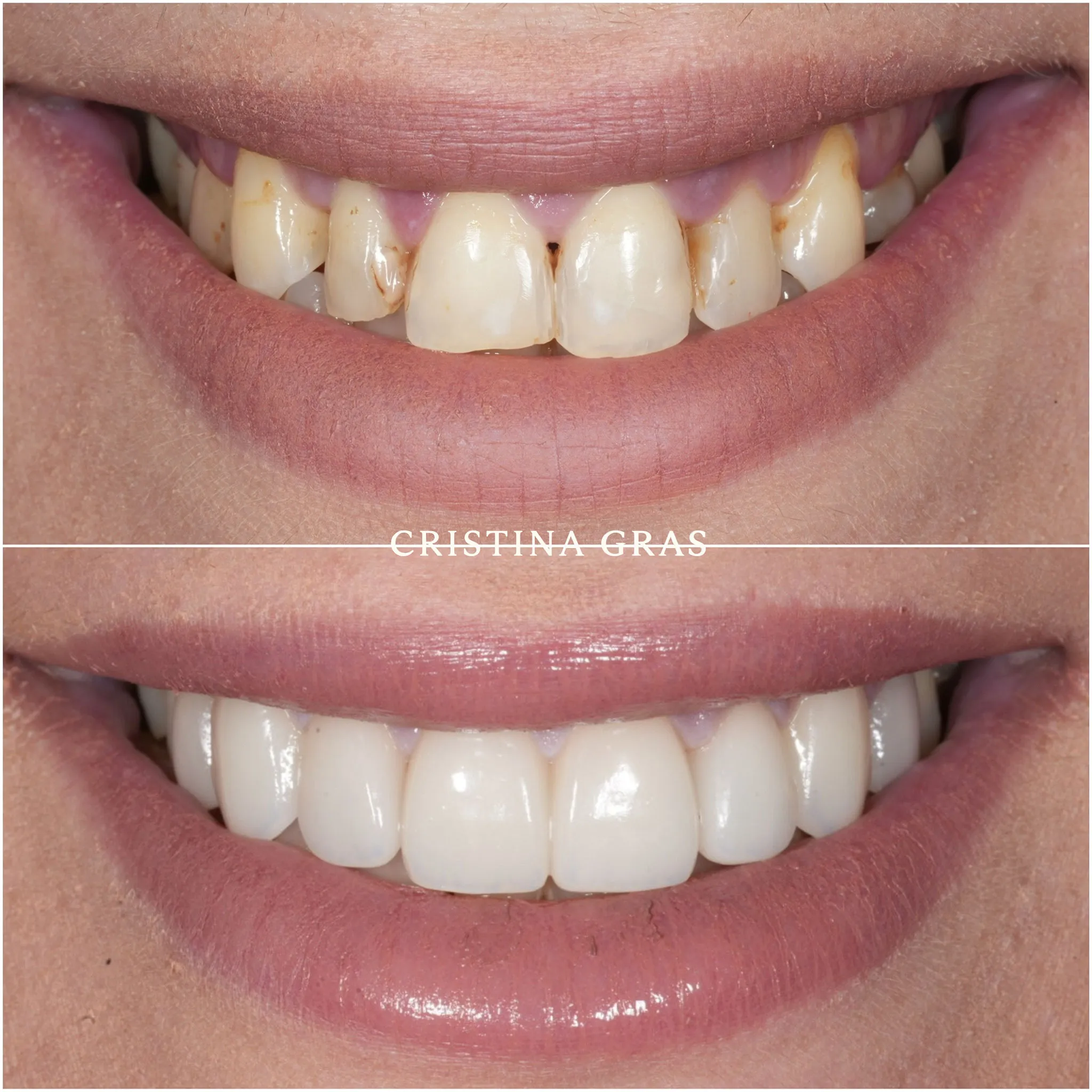 Diseño de sonrisa mediante carillas