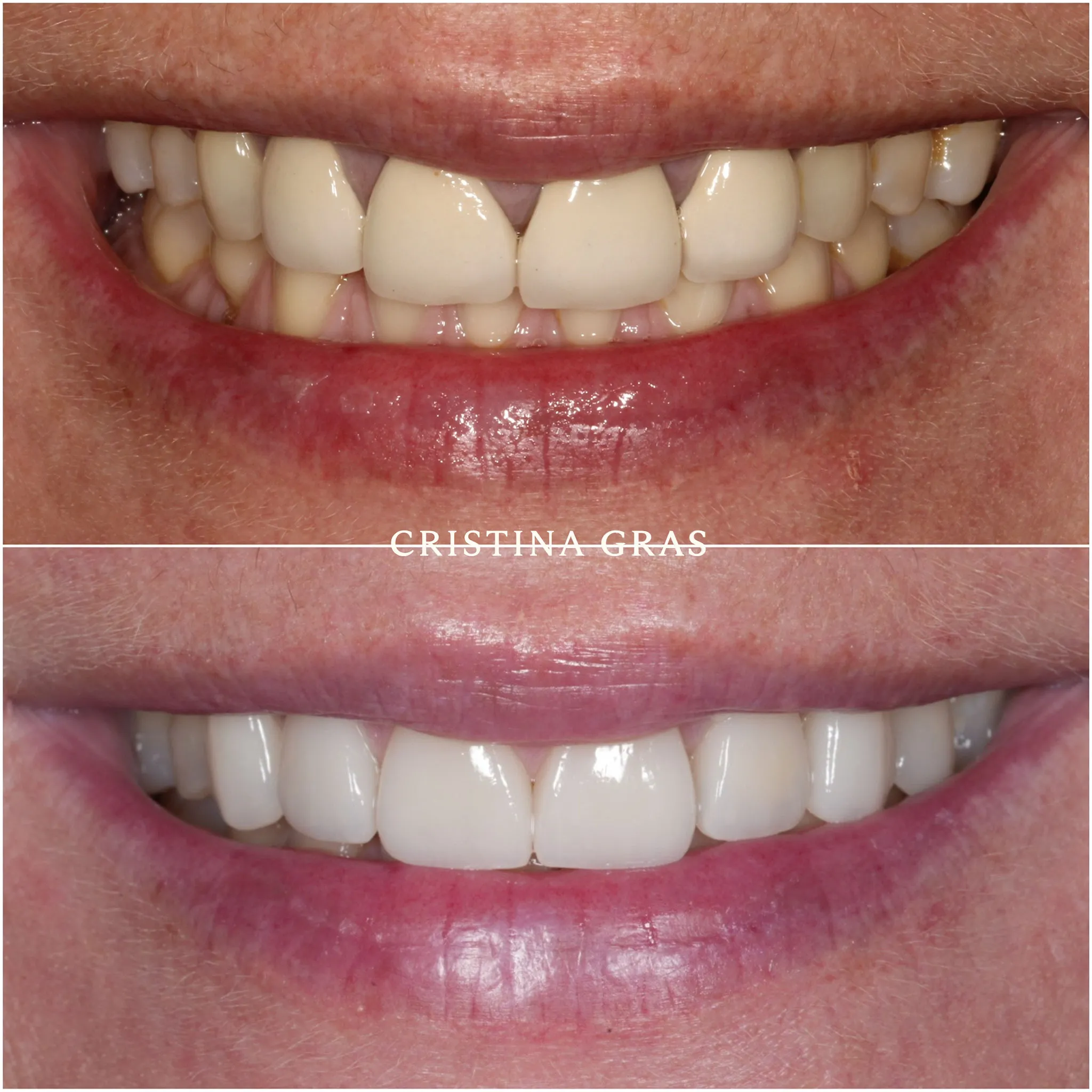 Sonrisa equilibrada con carillas personalizadas