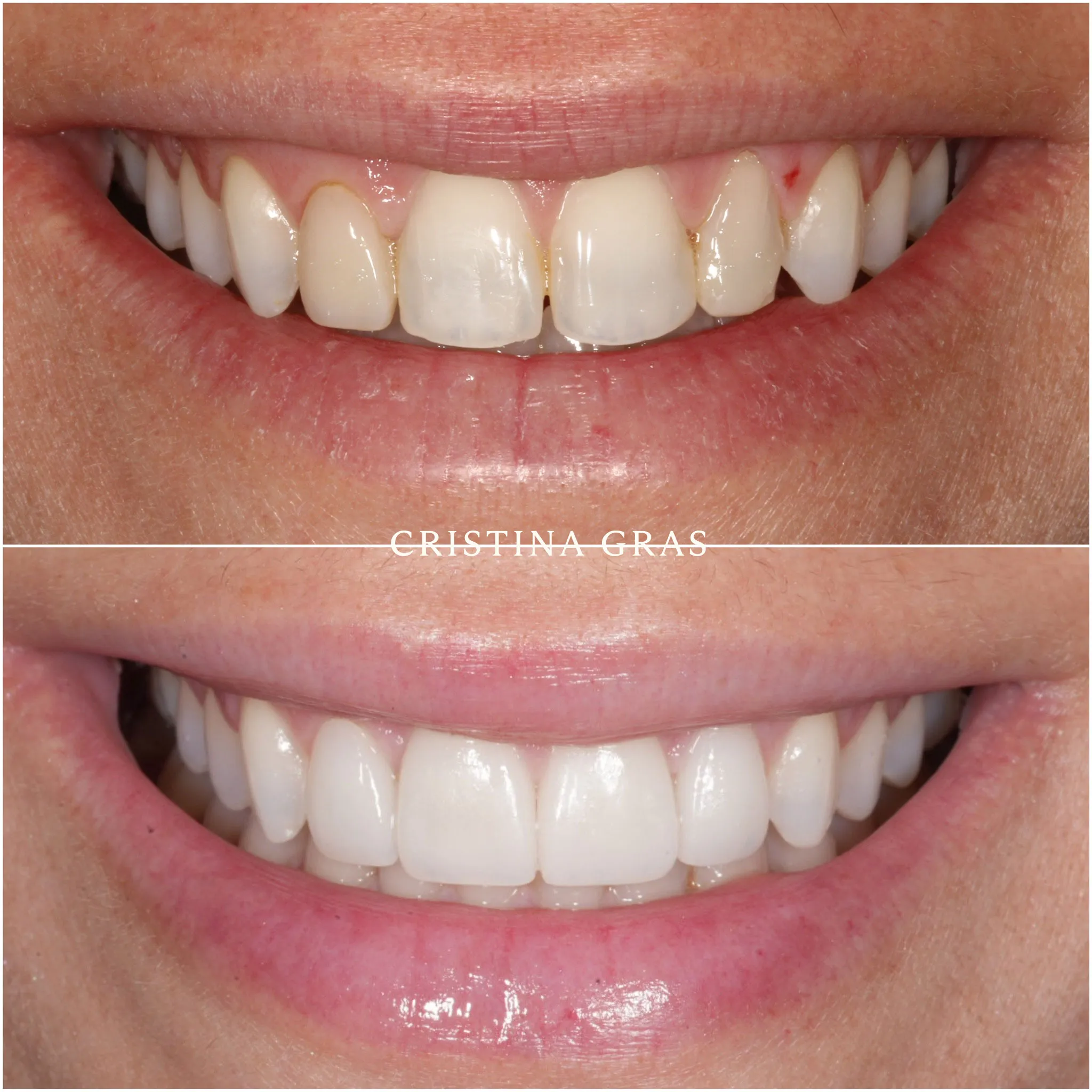 Carillas en tratamiento de estética dental avanzada