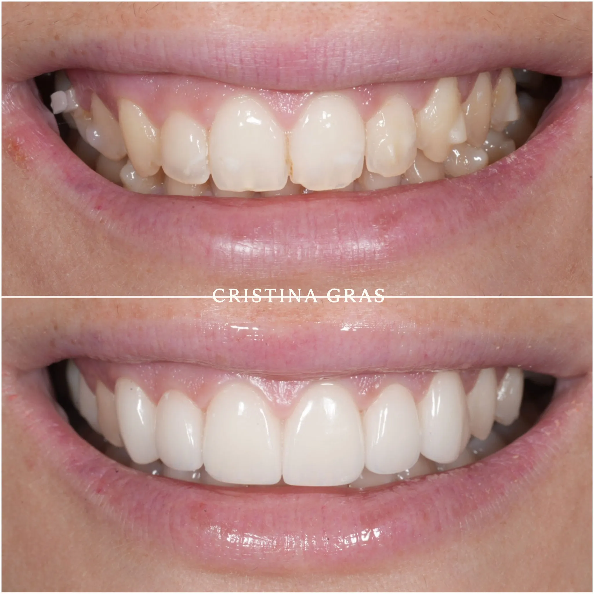 Restauración guía anterior con microcarillas de porcelana