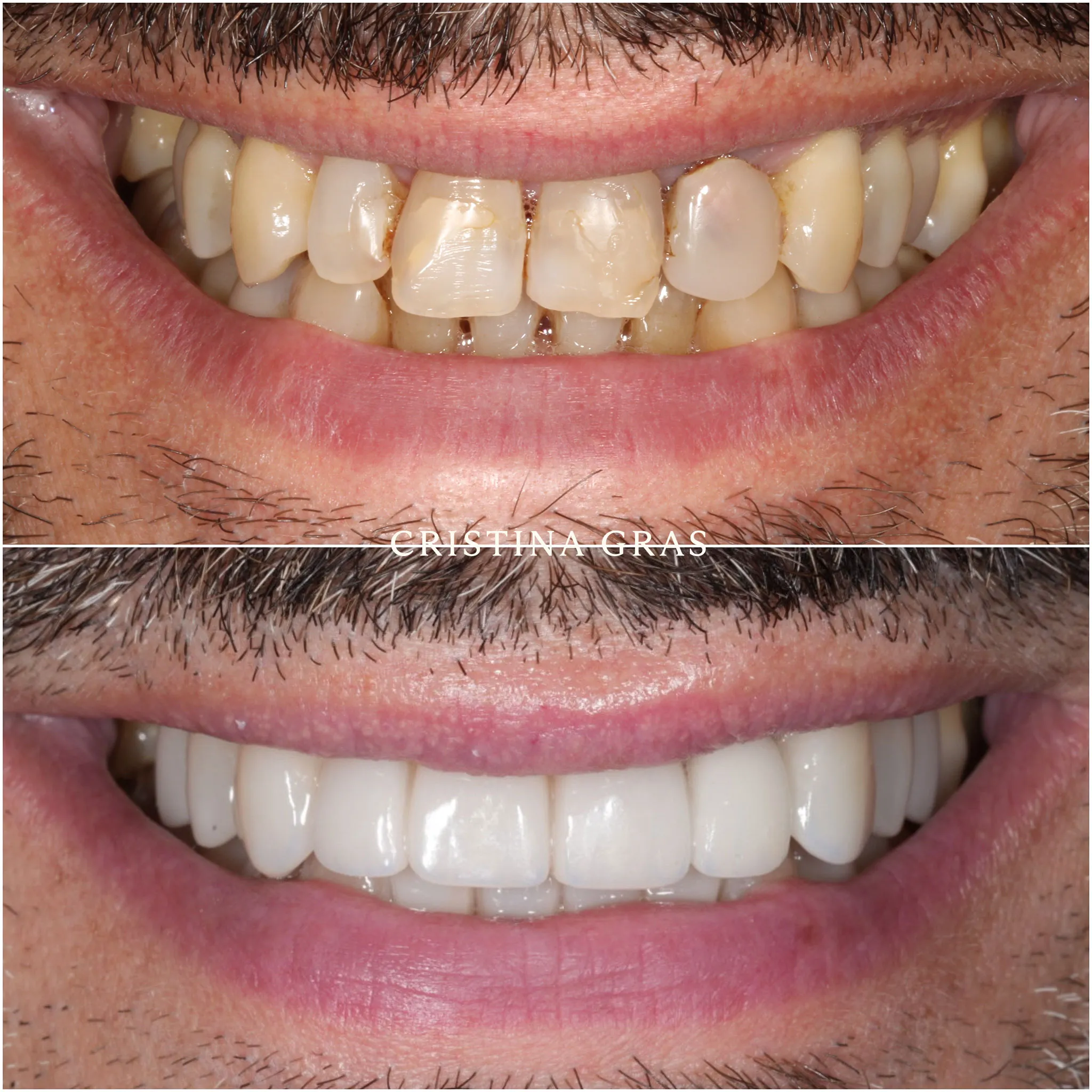 Rehabilitación completa con tratamiento adhesivo