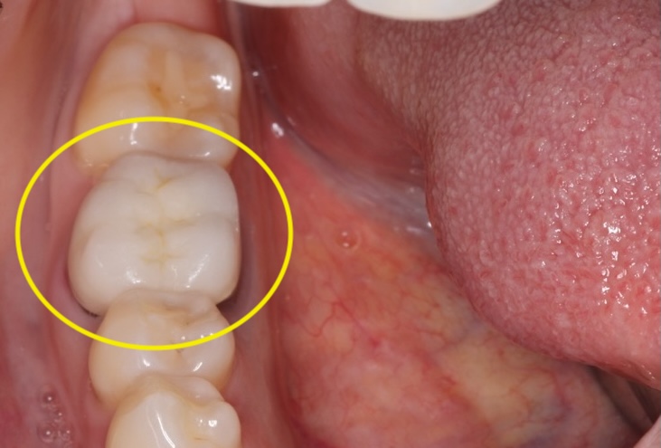 Before extraction of Lowe Right Molar ~ Tooth #30 on May 8, 2024