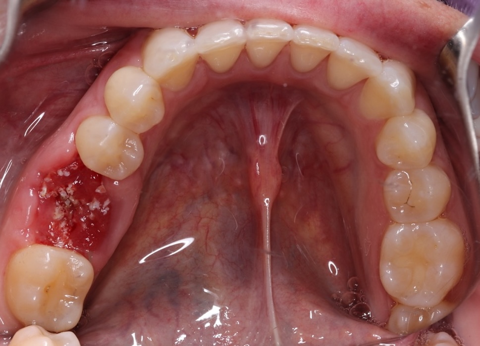 Membrane removal at Tooth #30 site on June 5, 2024