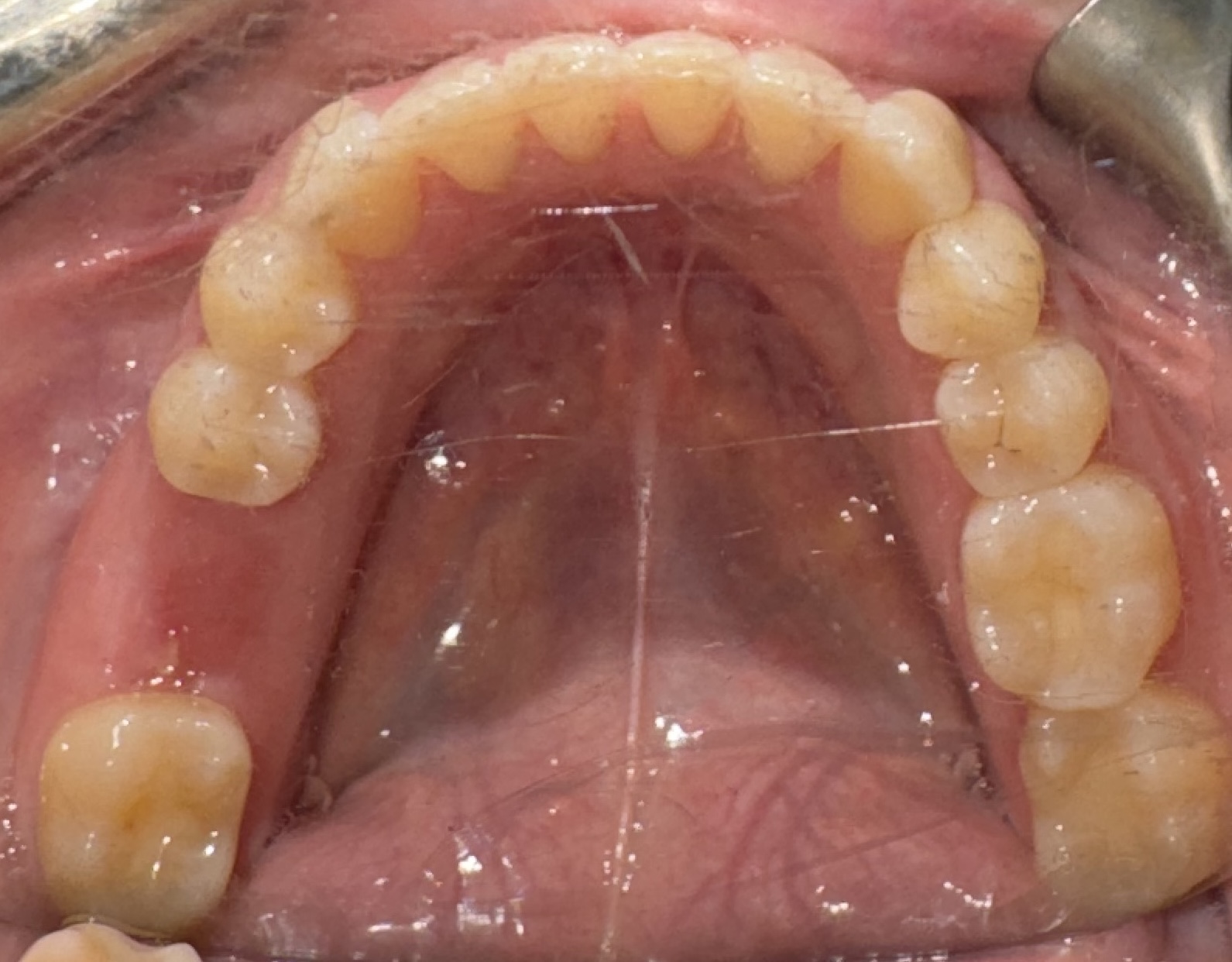 Post-operative view of Tooth #30 site on September 4, 2024
