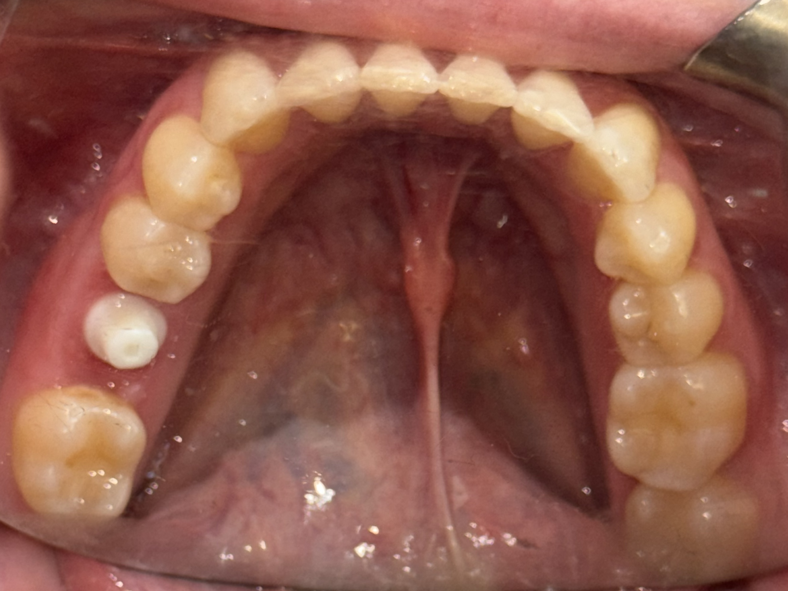Post-operative implant view at Tooth #30 on October 24, 2024