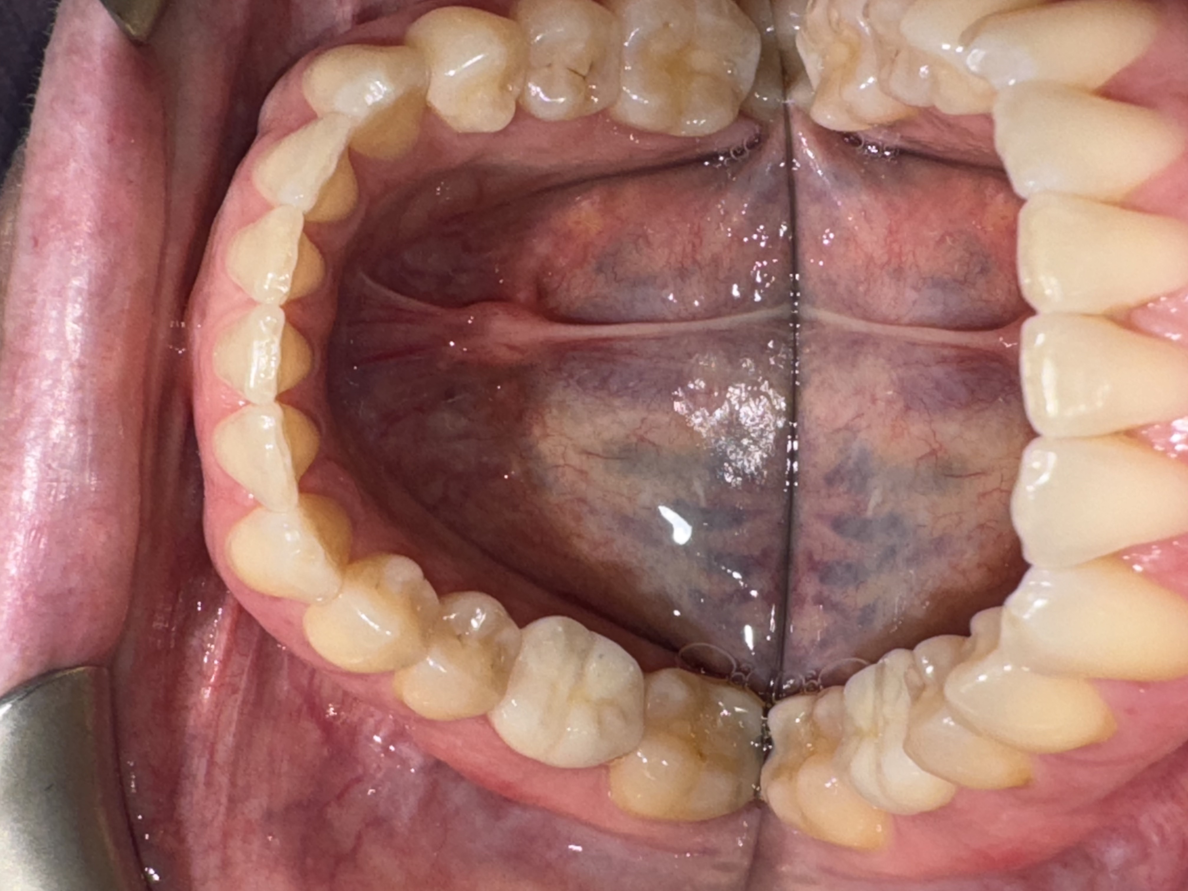 CBCT and clinical view of Tooth #30 implant case at Groton Wellness