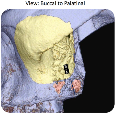 Initial imaging and clinical view of cavitation site area #16 on September 24, 2024
