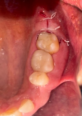 Intraoperative view during cavitation surgery at area #16 on December 4, 2024