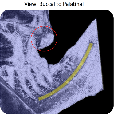 Follow-up view of healed cavitation site #16 on May 13, 2025