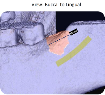 Initial imaging and clinical view of cavitation site area #17 on September 24, 2024