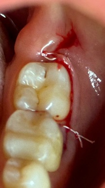 Intraoperative view during cavitation surgery at area #17 on October 8, 2024
