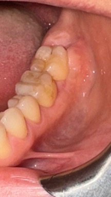 Healing at cavitation site #17 on October 22, 2024