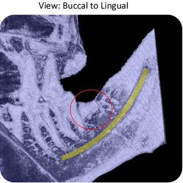 Follow-up view of healed cavitation site #17 on May 13, 2025