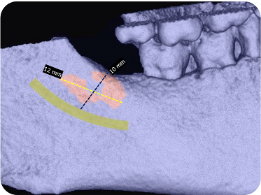 Initial imaging and clinical view of cavitation site area #32 on September 24, 2024