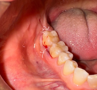 Intraoperative view during cavitation surgery at area #32 on October 22, 2024