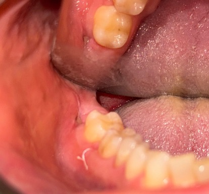Post-operative healing at cavitation site #32 on November 5, 2024