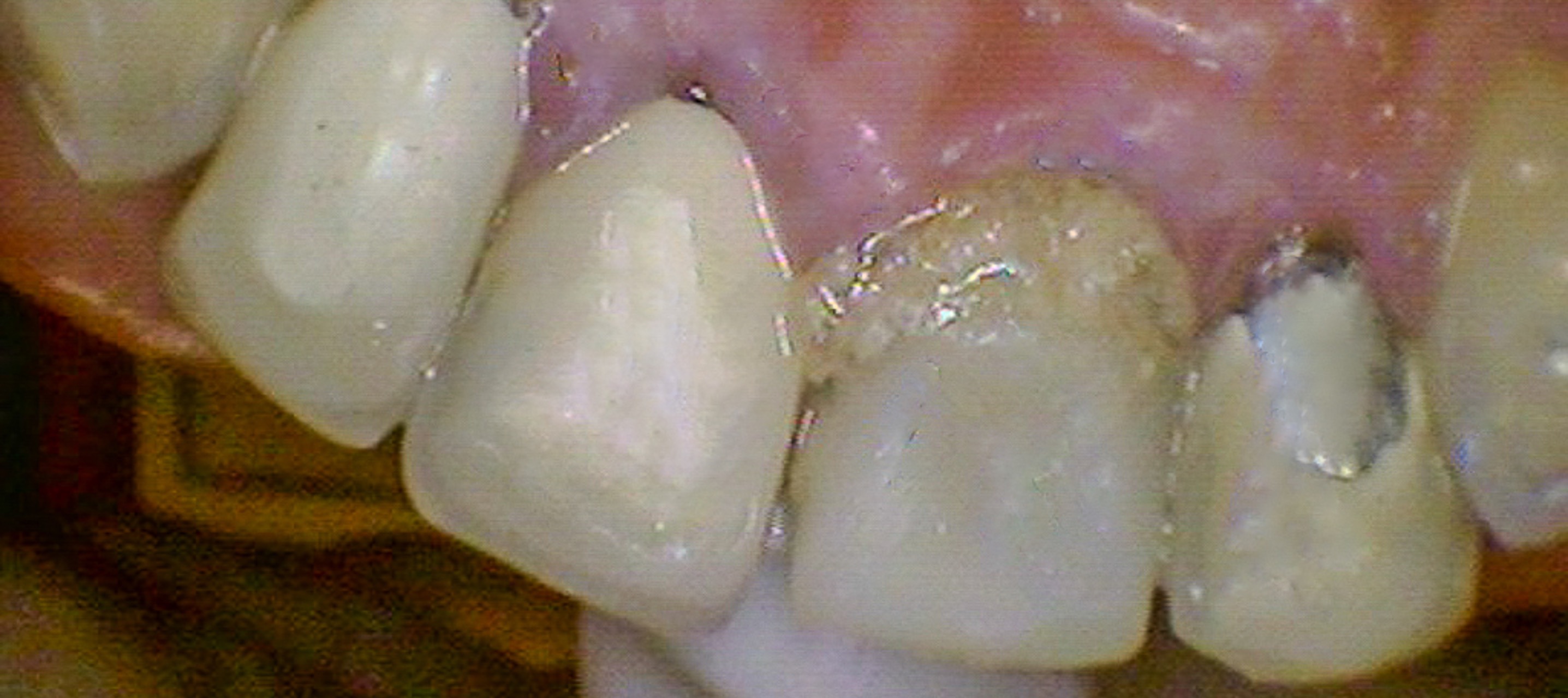 Pre-operative smile and clinical view of failing maxillary front teeth on September 25, 2021
