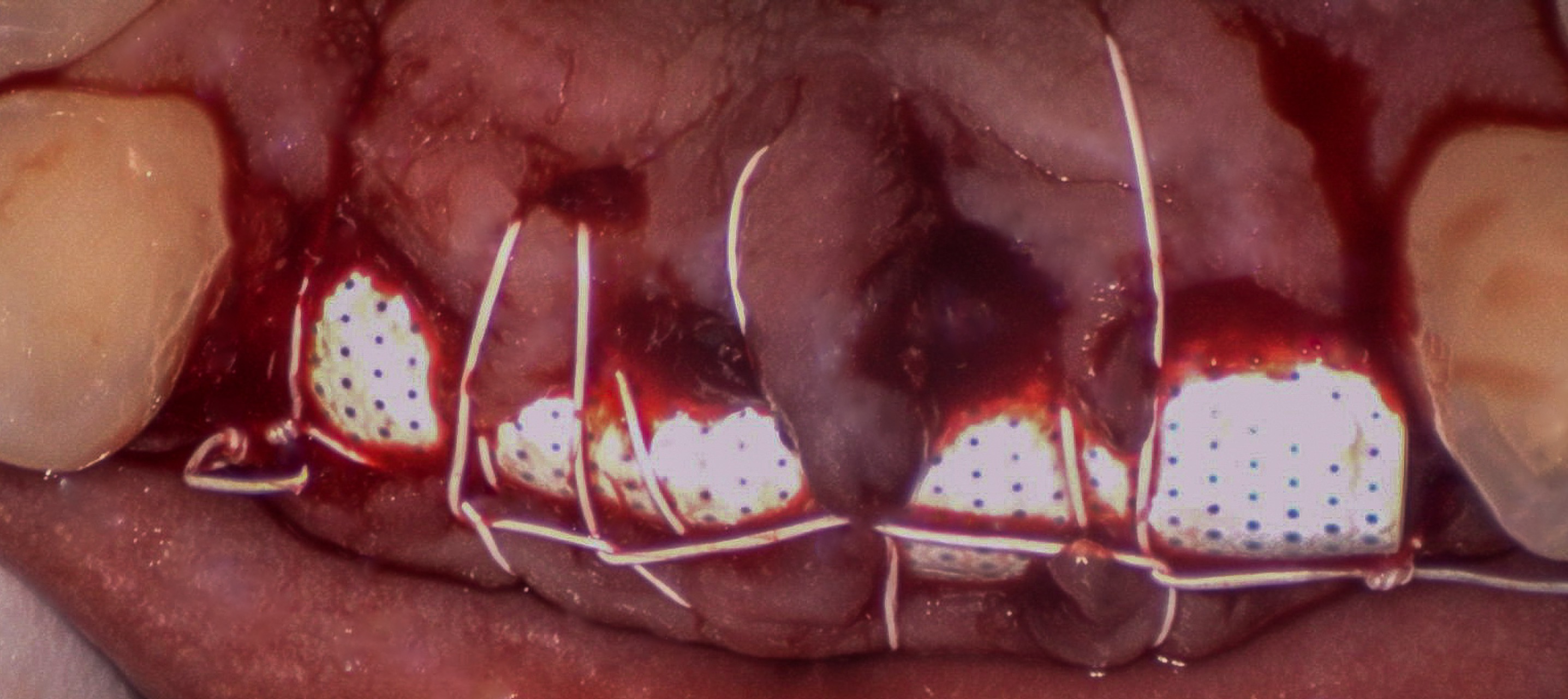 Updated imaging and planning views for anterior extraction and GBR on November 18, 2023