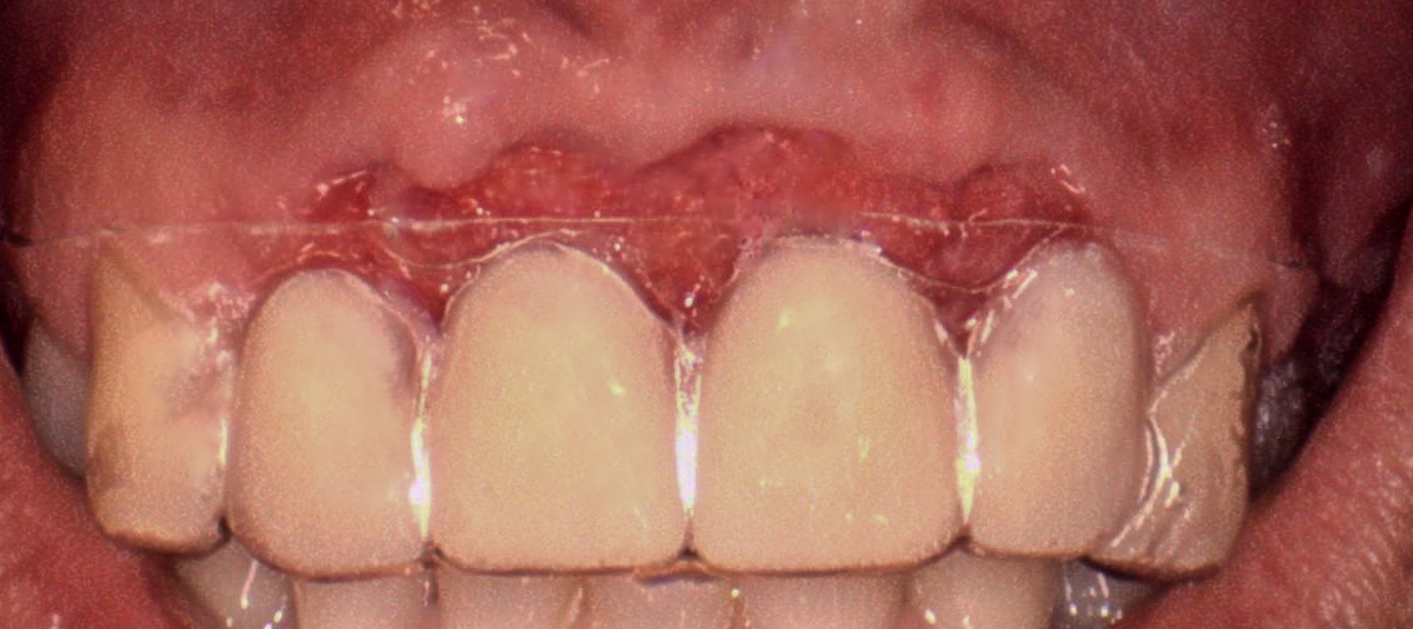 Intraoperative view during extraction and guided bone regeneration of teeth #7–10 on December 7, 2023