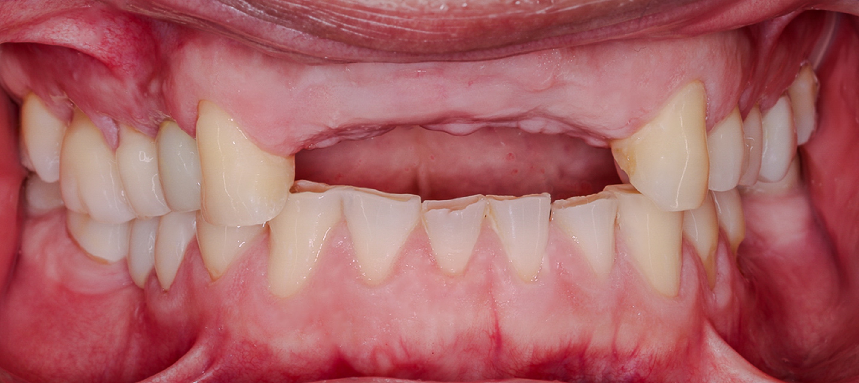 Early healing aspect of anterior ridge after extraction and GBR