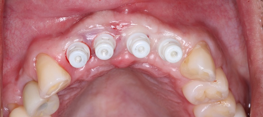 Provisional restorations supporting soft tissue contours on March 6, 2024