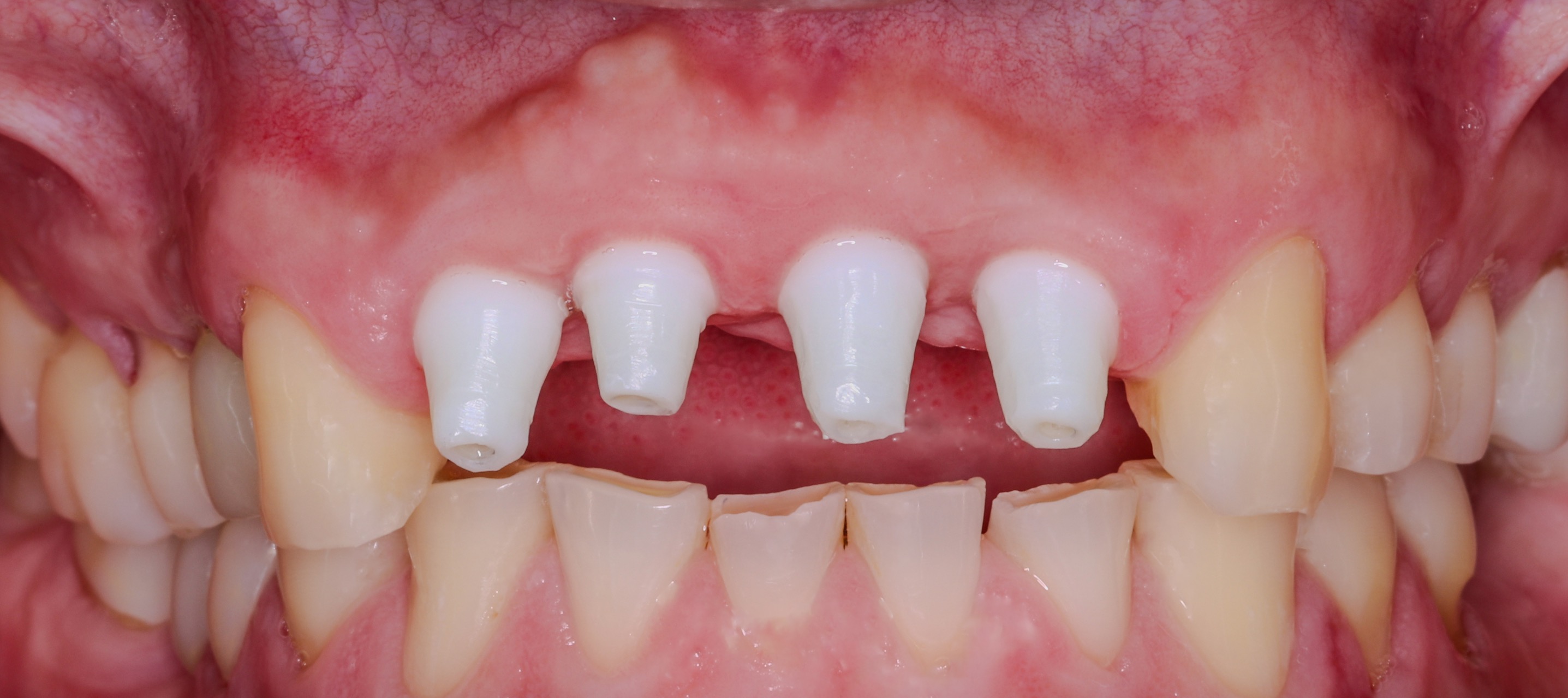 Follow-up showing soft tissue health around anterior implants on June 8, 2024