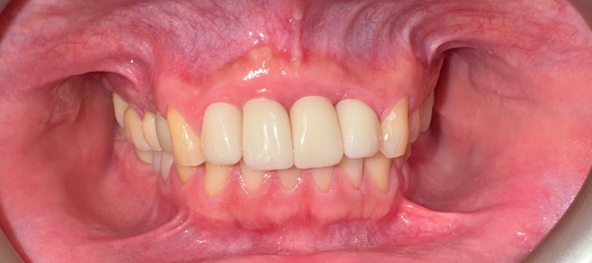 Final anterior implant-supported restorations on March 29, 2025