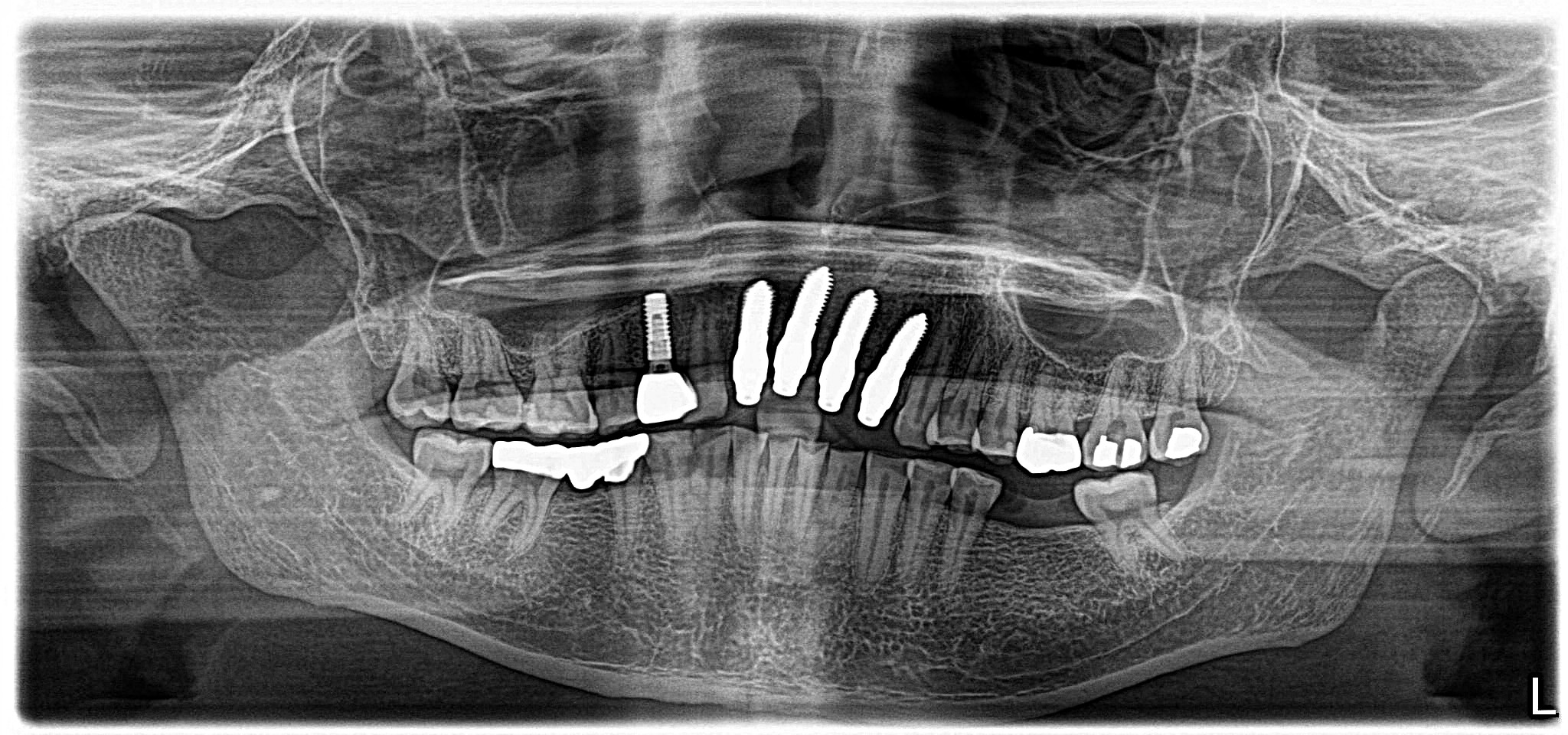 After treatment smile photo showing final anterior implant restorations for Ivan E