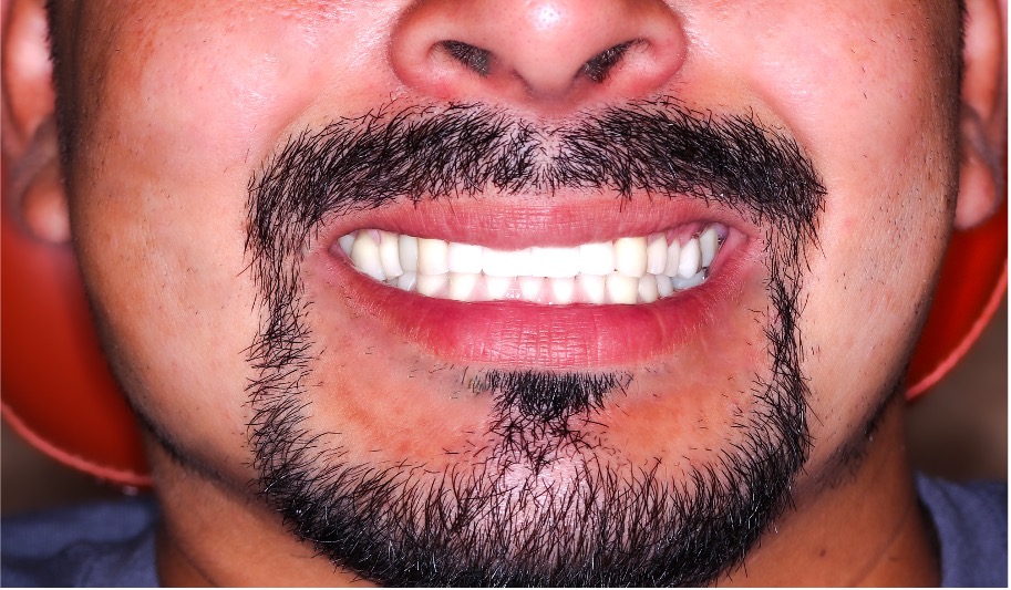 Pre- and post-treatment views of maxillary front implant case for Ivan E at Groton Wellness