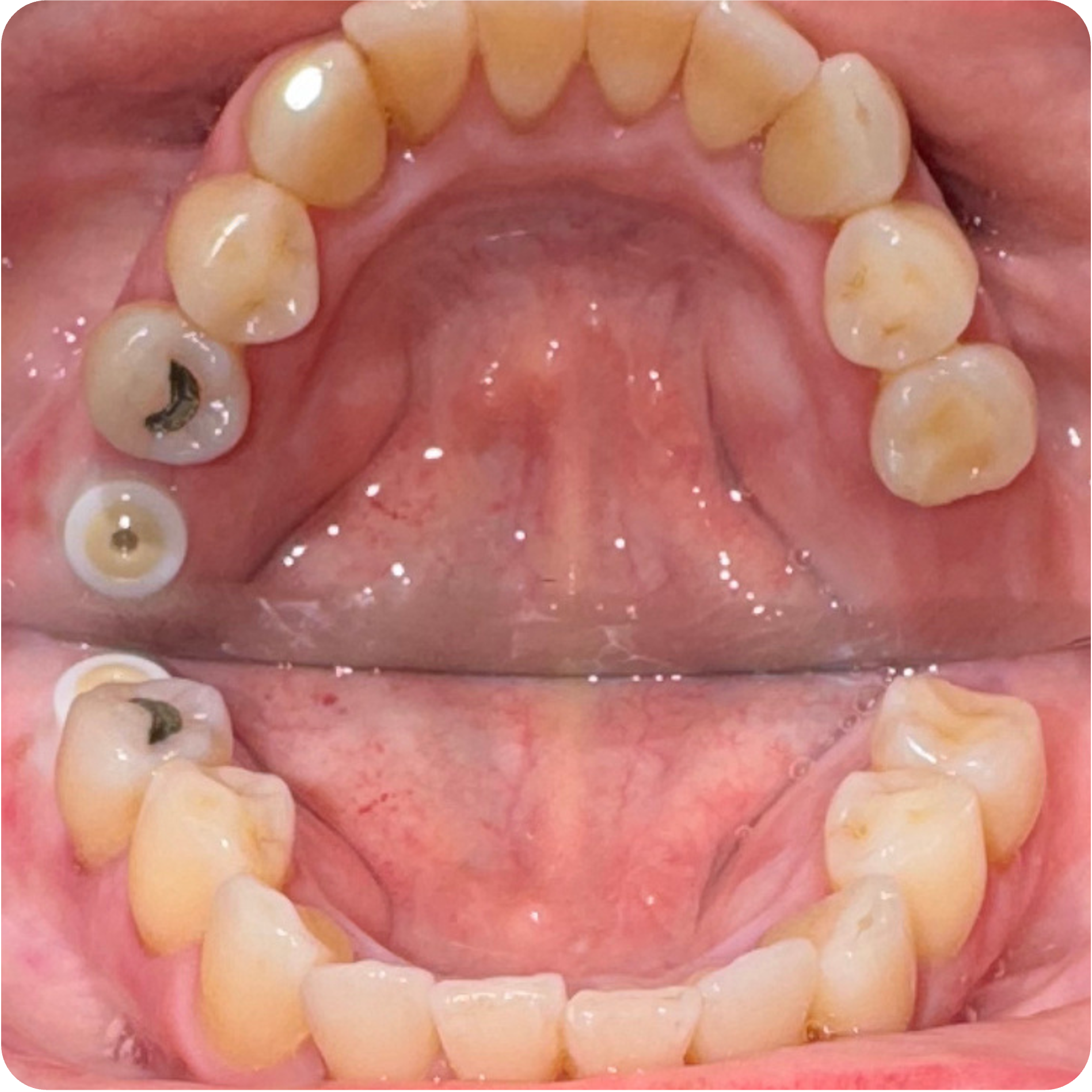 Extraction with bone grafting of teeth 14 15 18 19 on June 26, 2025