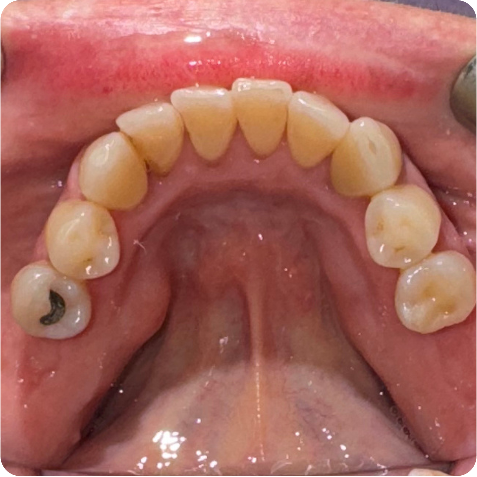 Membrane removal visit on June 12, 2025