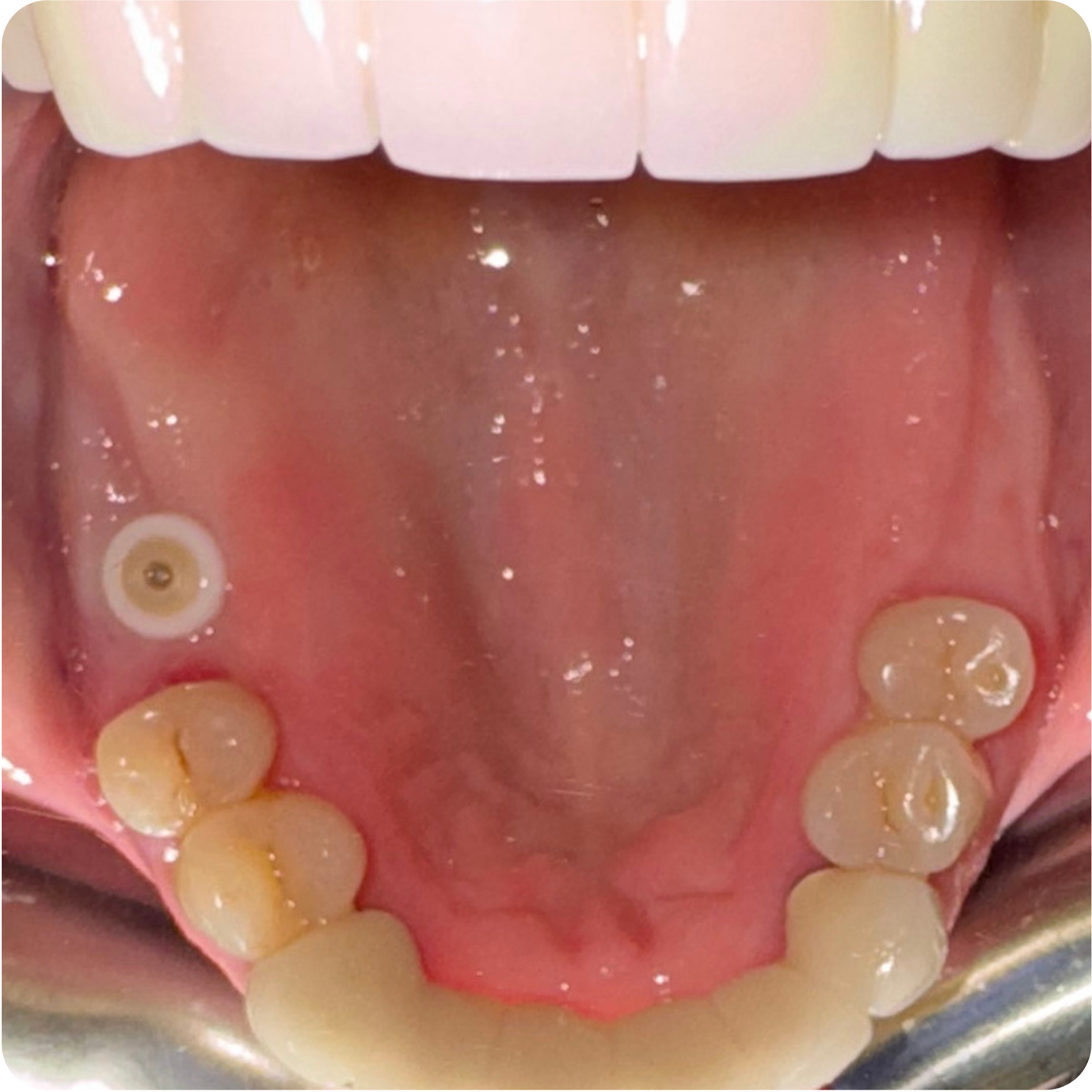 Follow-up and questionnaire version 2 visit on January 14, 2026