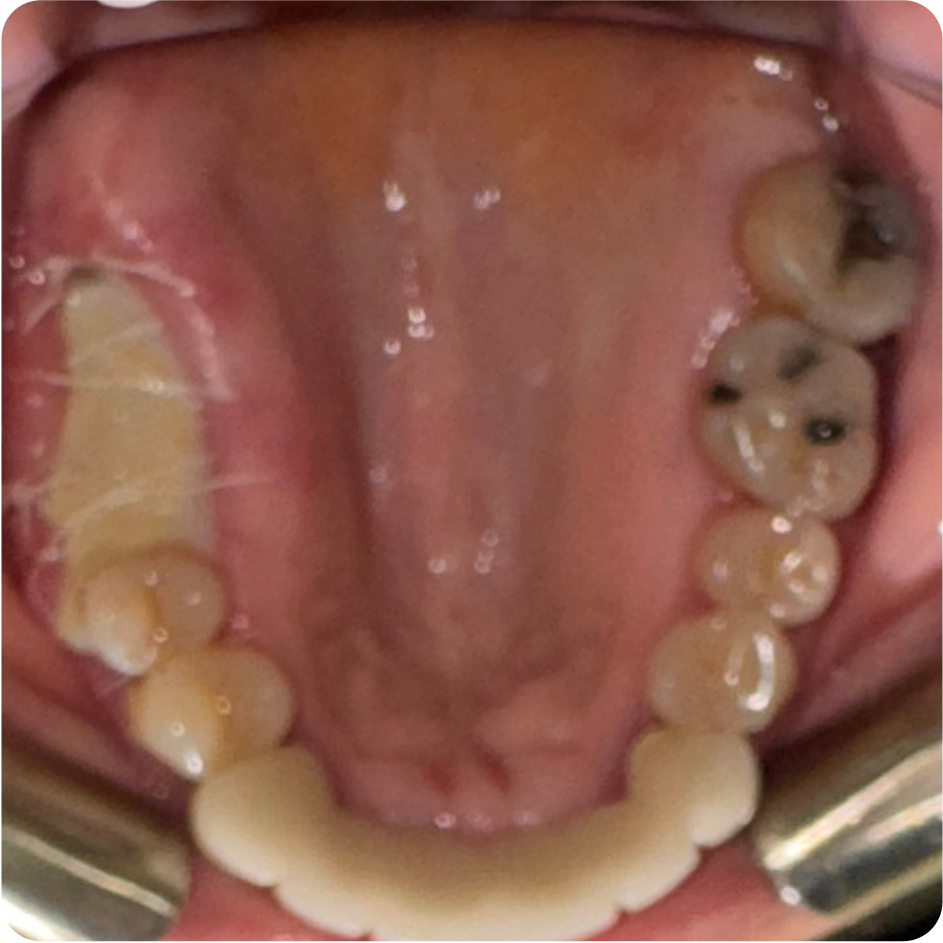 Periodontal scaling and root planing visit on September 18, 2025