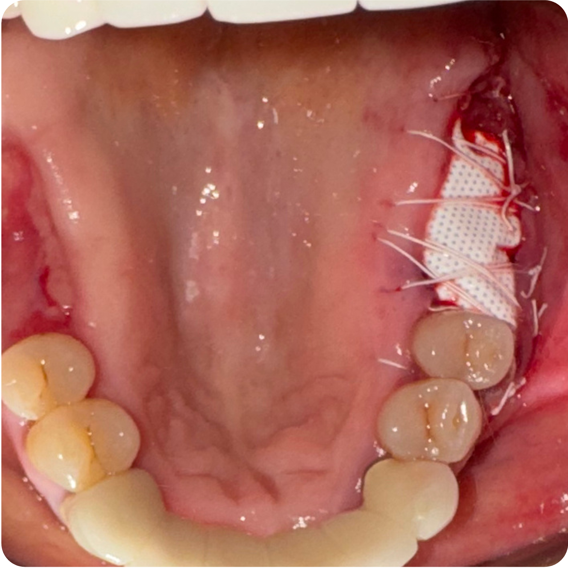 Implant placement at sites 3 and 30 on November 26, 2025