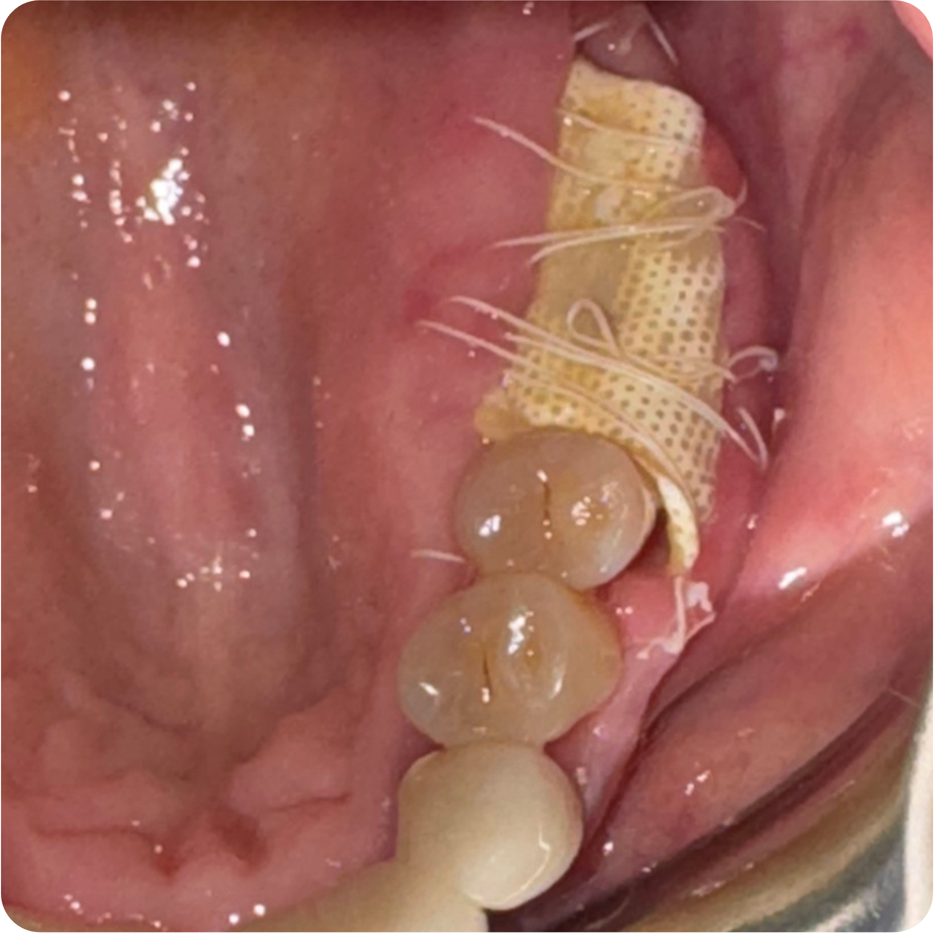 Implant placement at sites 14 and 19 on December 2, 2025