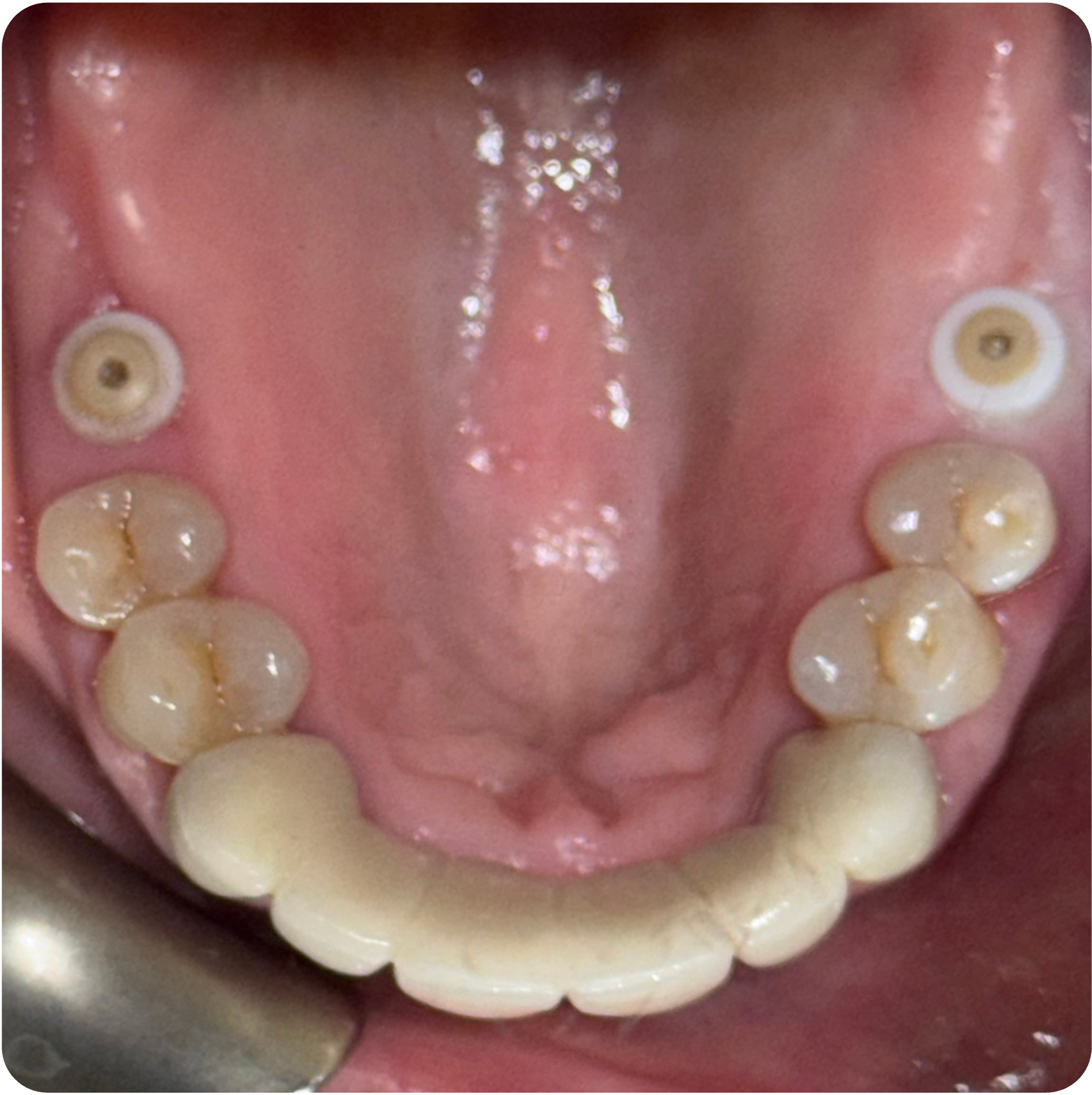 Follow-up and questionnaire version 2 visit on January 14, 2026